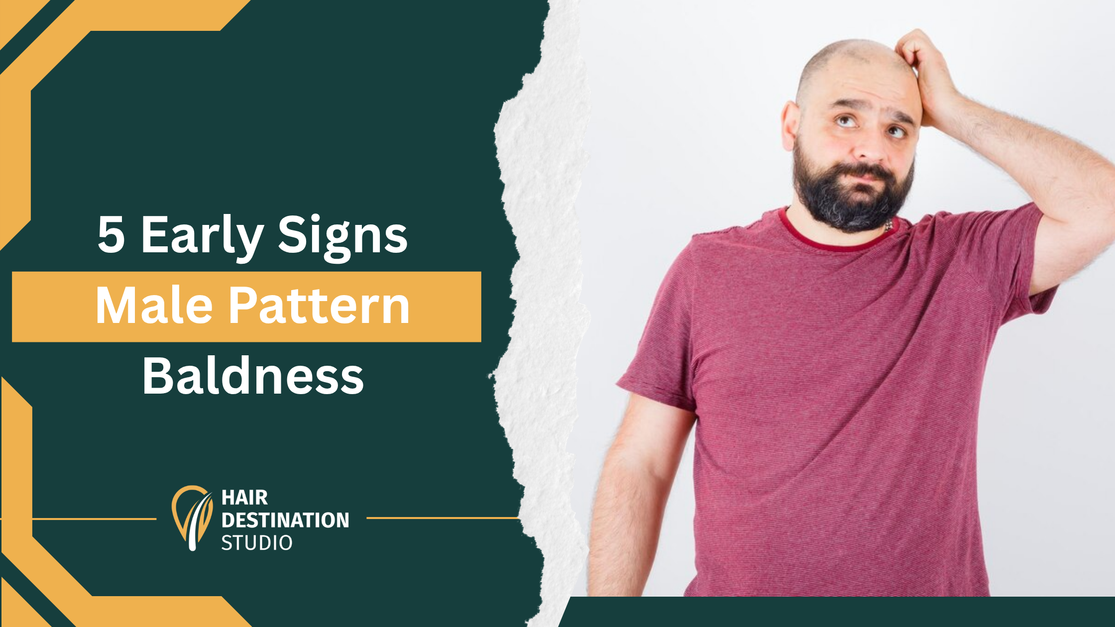5 Early Signs of Male Pattern Baldness You Should Never Ignore